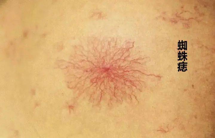 痣在哪长癌从哪来身上这3种痣最危险洗澡时多看一眼能救命