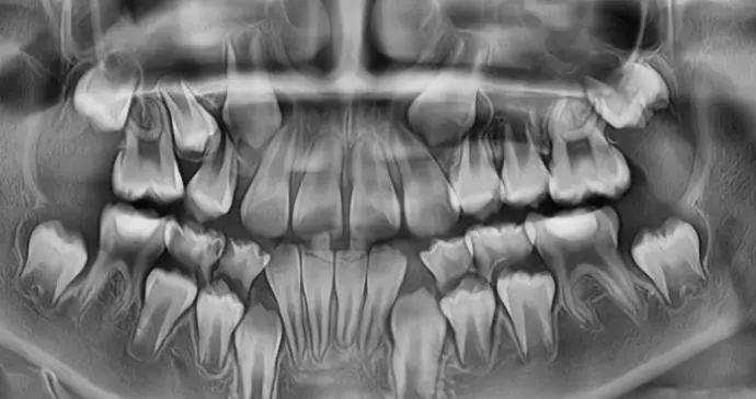 牙齿_口腔_前牙