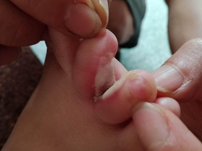 脚趾缝糜烂发痒真难受自爆自用去除脚糜烂发痒攻略指南重回光滑细腻