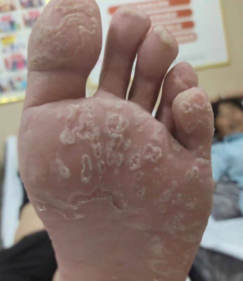 我们要了解导致脚气发生的原因,通过学习我知道了脚气是由真菌感染