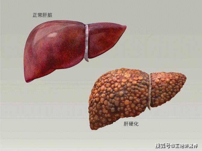 它的表面光滑,颜色红润,体积正常;右面是一个硬化了的肝脏,它的表面