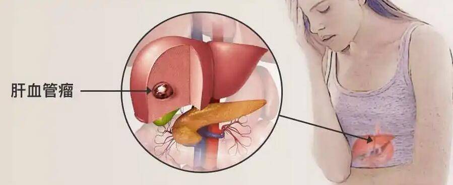 肝血管瘤症状图片