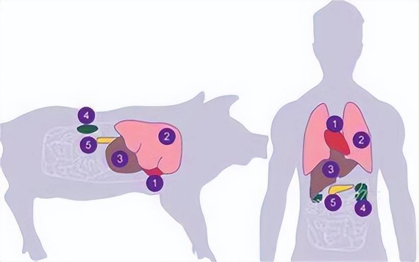 全球首例活体人异种肝移植手术成功:"猪到人"器官移植时代来了?