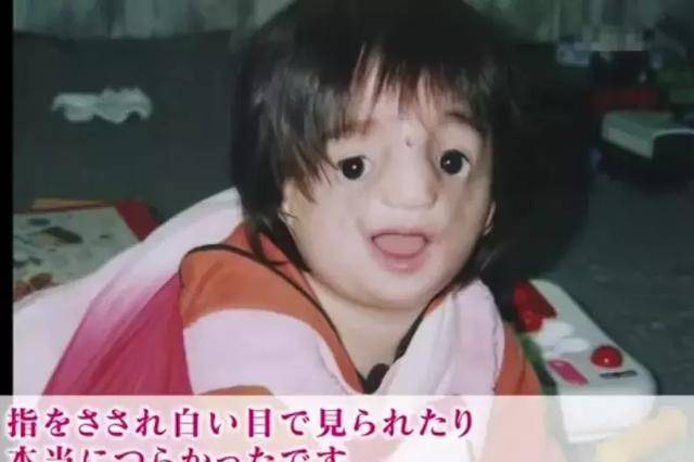 五万人一遇的无脸症:面部畸形被同学嘲笑,却让700校友集体落泪