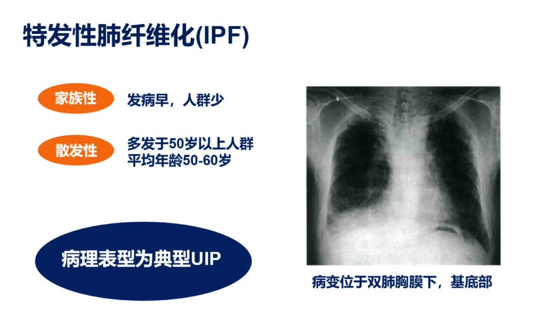 间质性肺炎与肺纤维化:区分,分类及特点概览