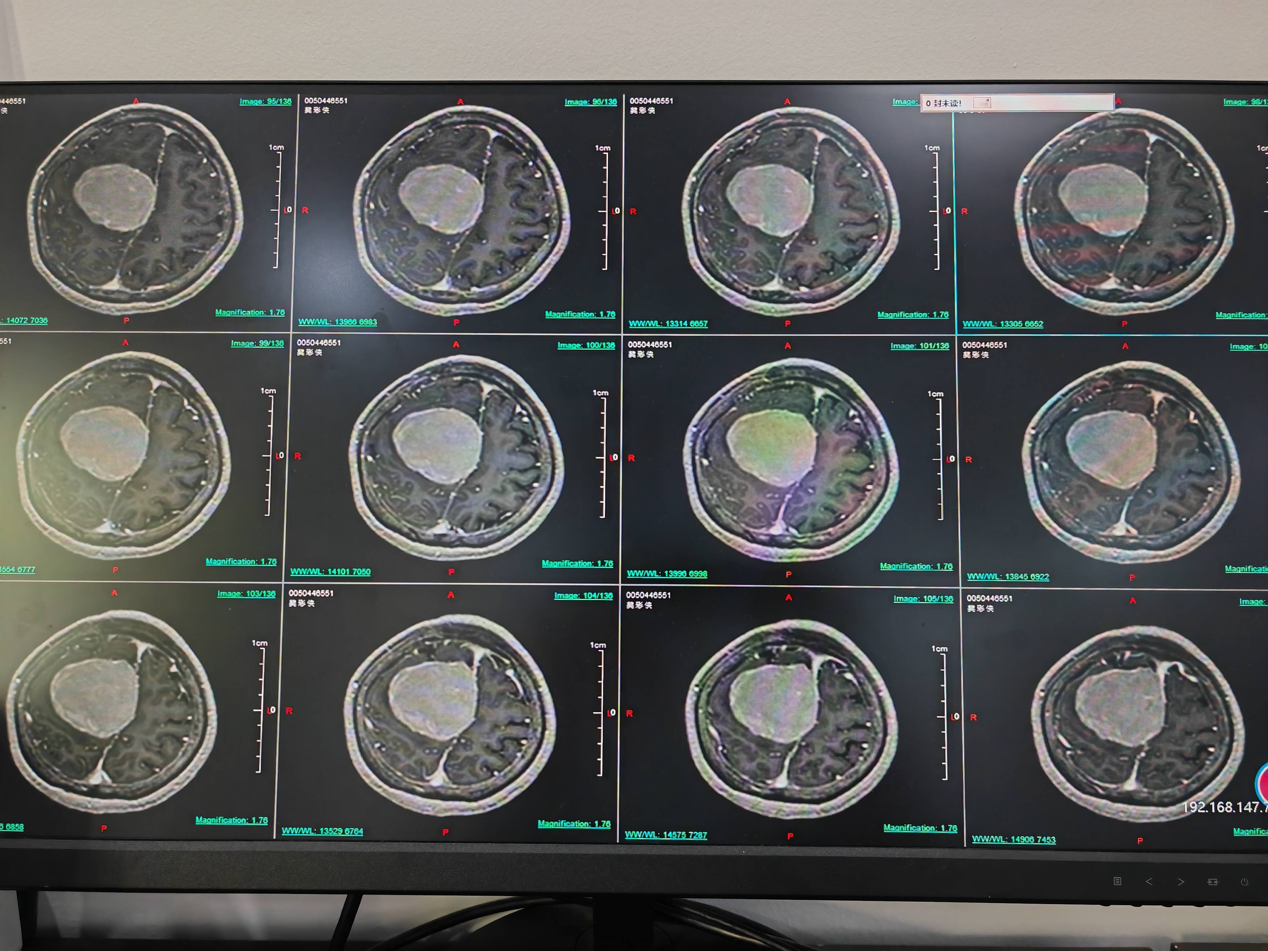 的占位,进一步进行核磁共振检查后,确诊为镰旁脑膜瘤,肿瘤已经长到5