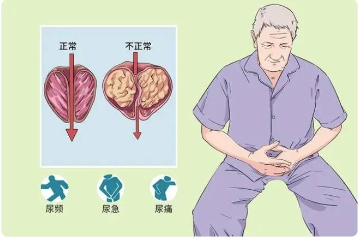 夜尿频,尿滴沥不尽,前列腺增生困扰中老年男性生活