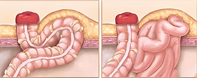 合肥中山外科医院"谈疝不必色变"——造口旁疝知多少
