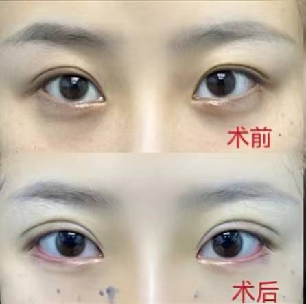连云港华美李超丨切双眼皮前后对比_手术_效果_眼睑