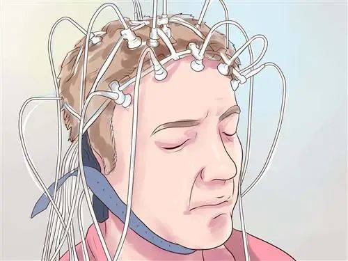 小发作,医学术语中癫痫分类中的小发作,指的是全面性发作中的失神发作