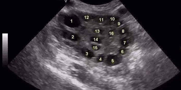 多囊卵巢综合症的临床表现(卵泡多是多囊卵巢综合征吗)