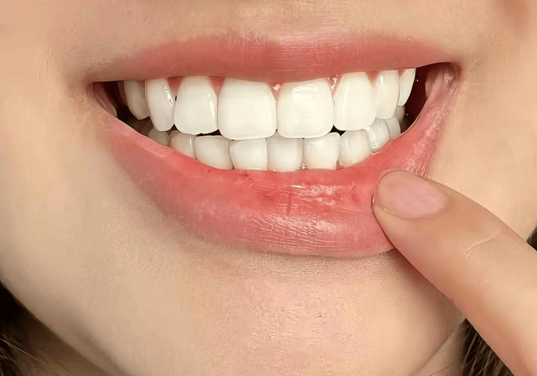 后面又连着用了一个月左右,牙齿的颜色就比之前整整白了好几个度!