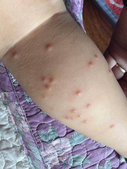 浑身痒越抓越痒起疙瘩的深层原因皮肤过敏:这是最常见的诱因之一.