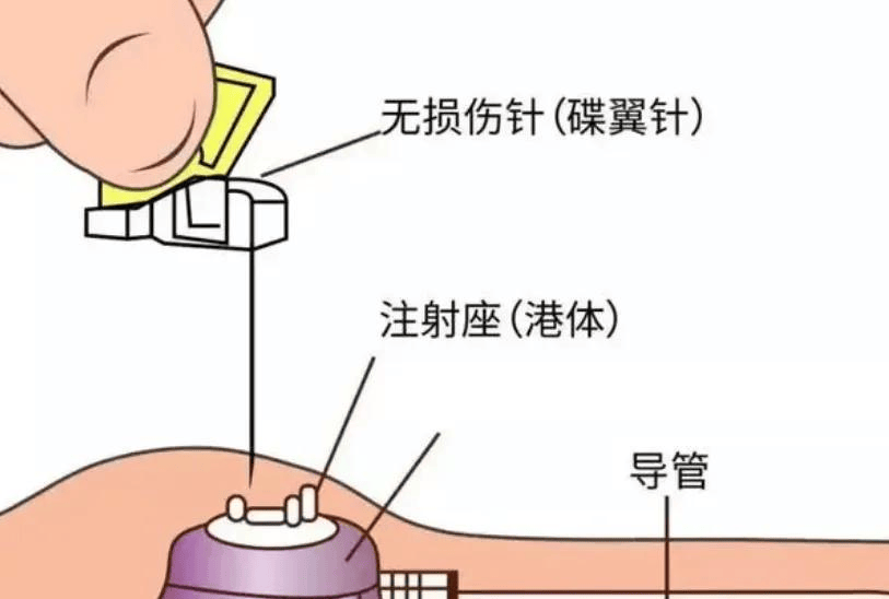 输液港置管位置图解图片