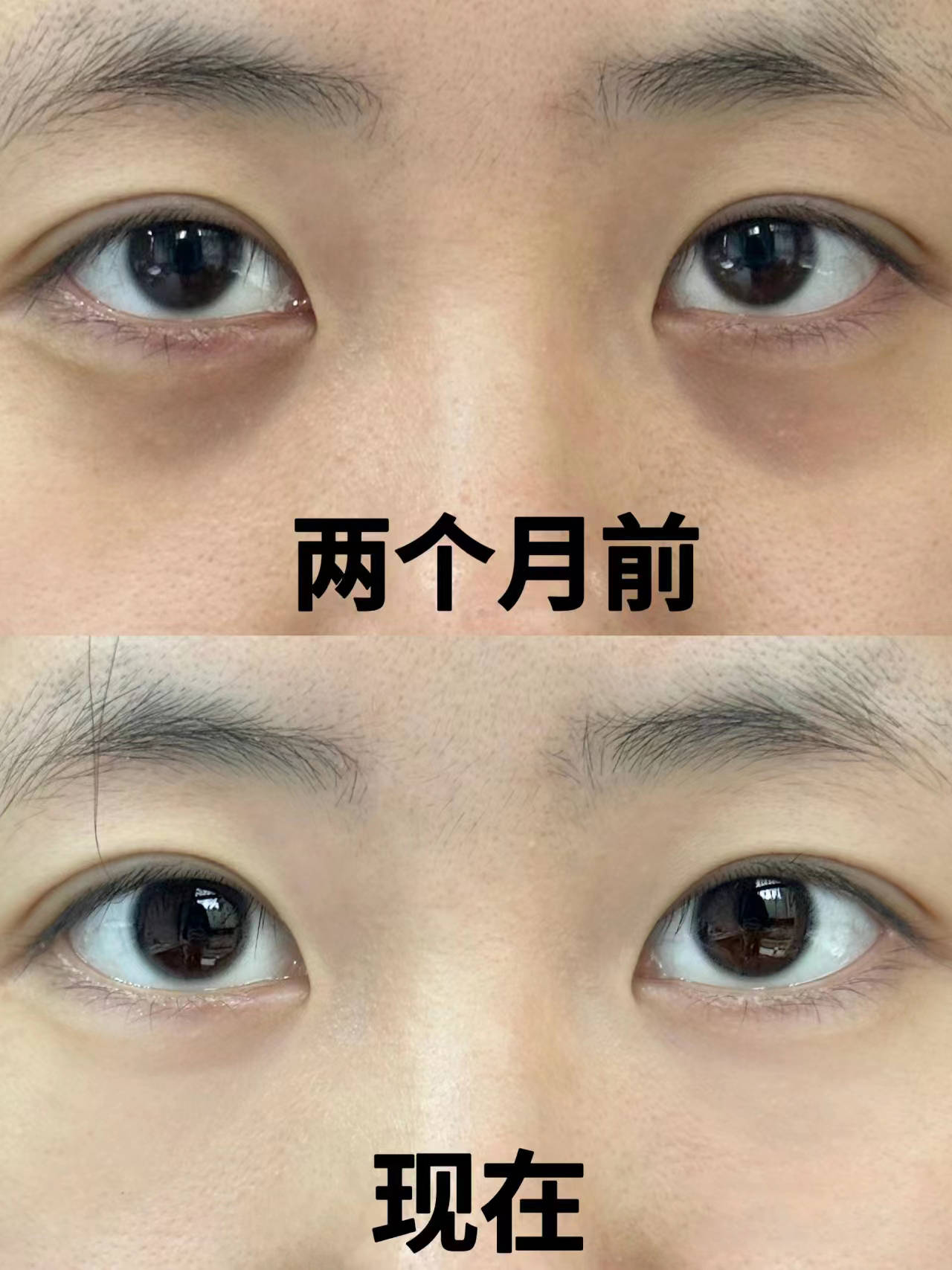 组合,可以帮助渗透到肌底,促进肌肤胶原蛋白再生,帮助淡化结构性纹路