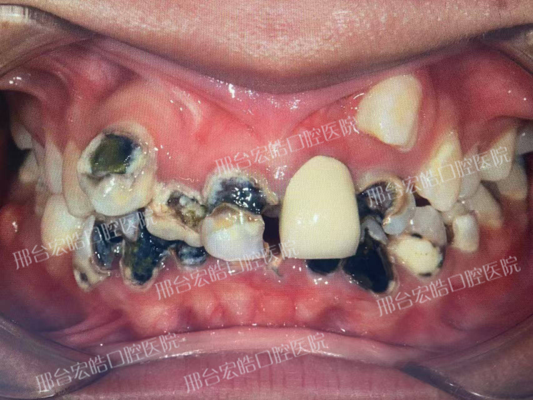 邢台口腔修复专家:中学生蛀牙导致多颗牙齿脱落,如何治疗?