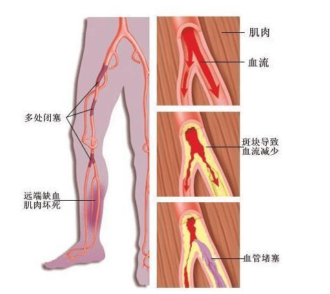 大腿股动脉位置图片图片