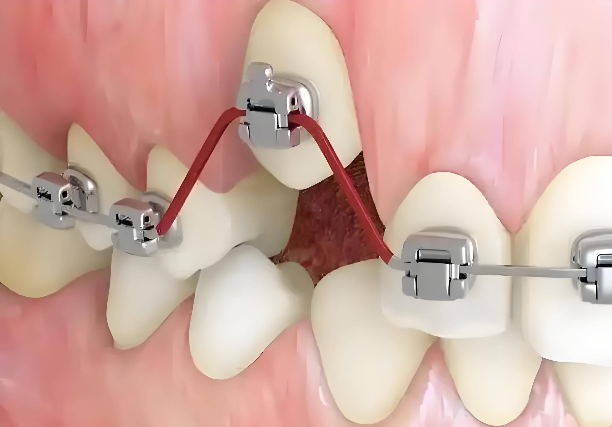 邢台正畸专家:为何牙齿在矫正过程中一个月只能移动约1毫米?