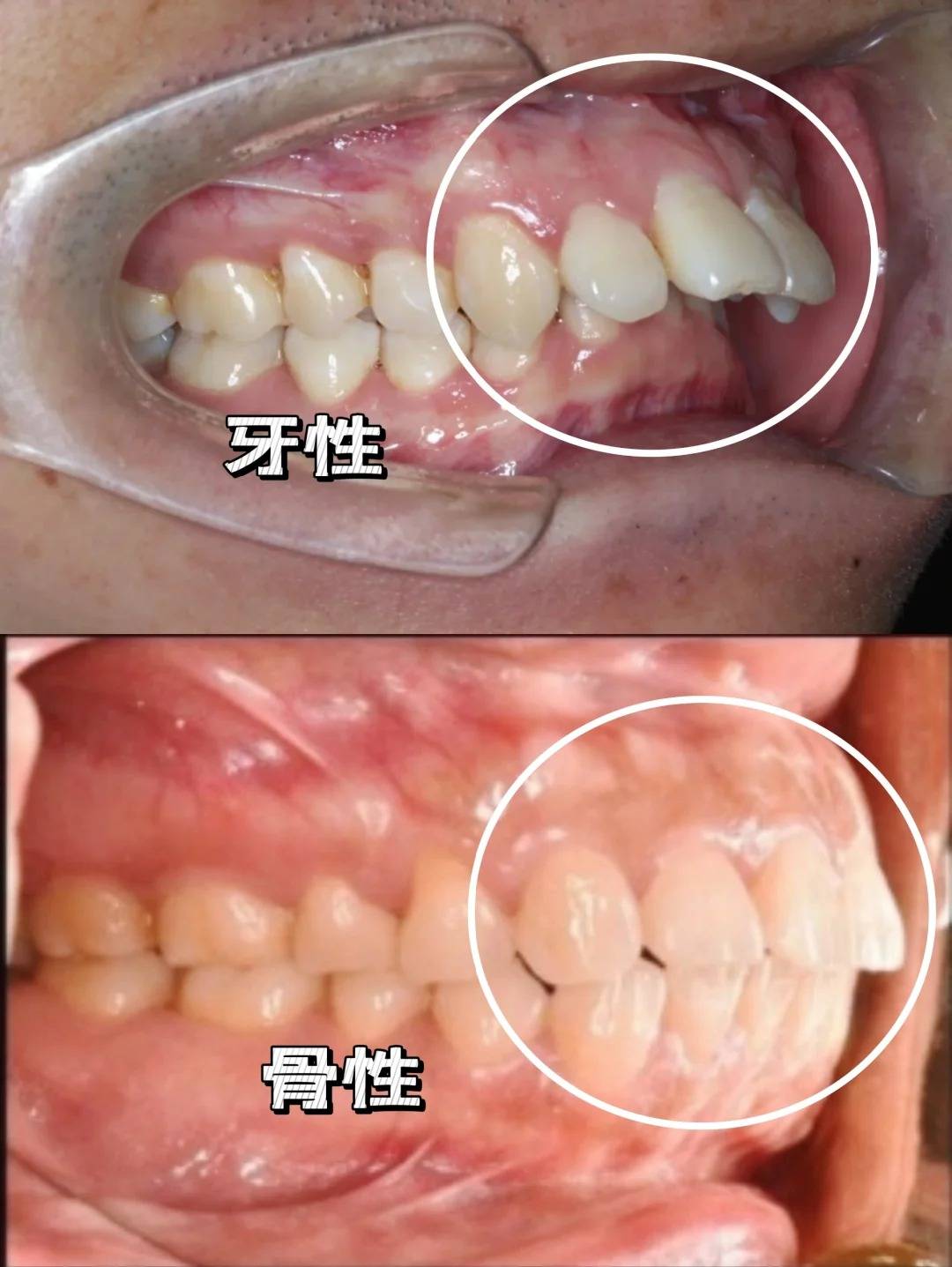 邢台正畸专家骨性龅牙前突是先天的还是后天造成的