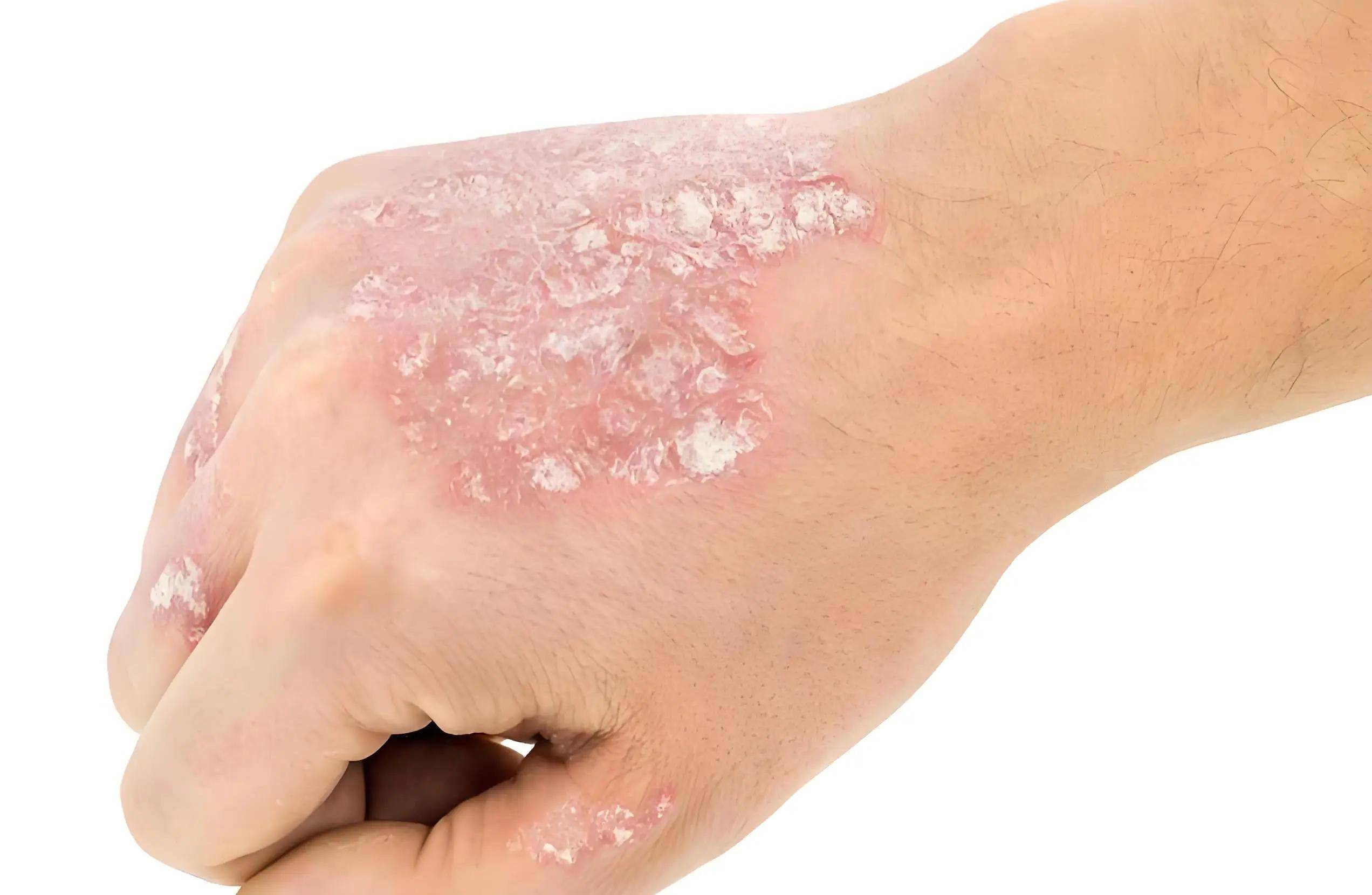 崇文门中医医院张弘医生:银屑病会传染吗?看看这些你都做到了吗?