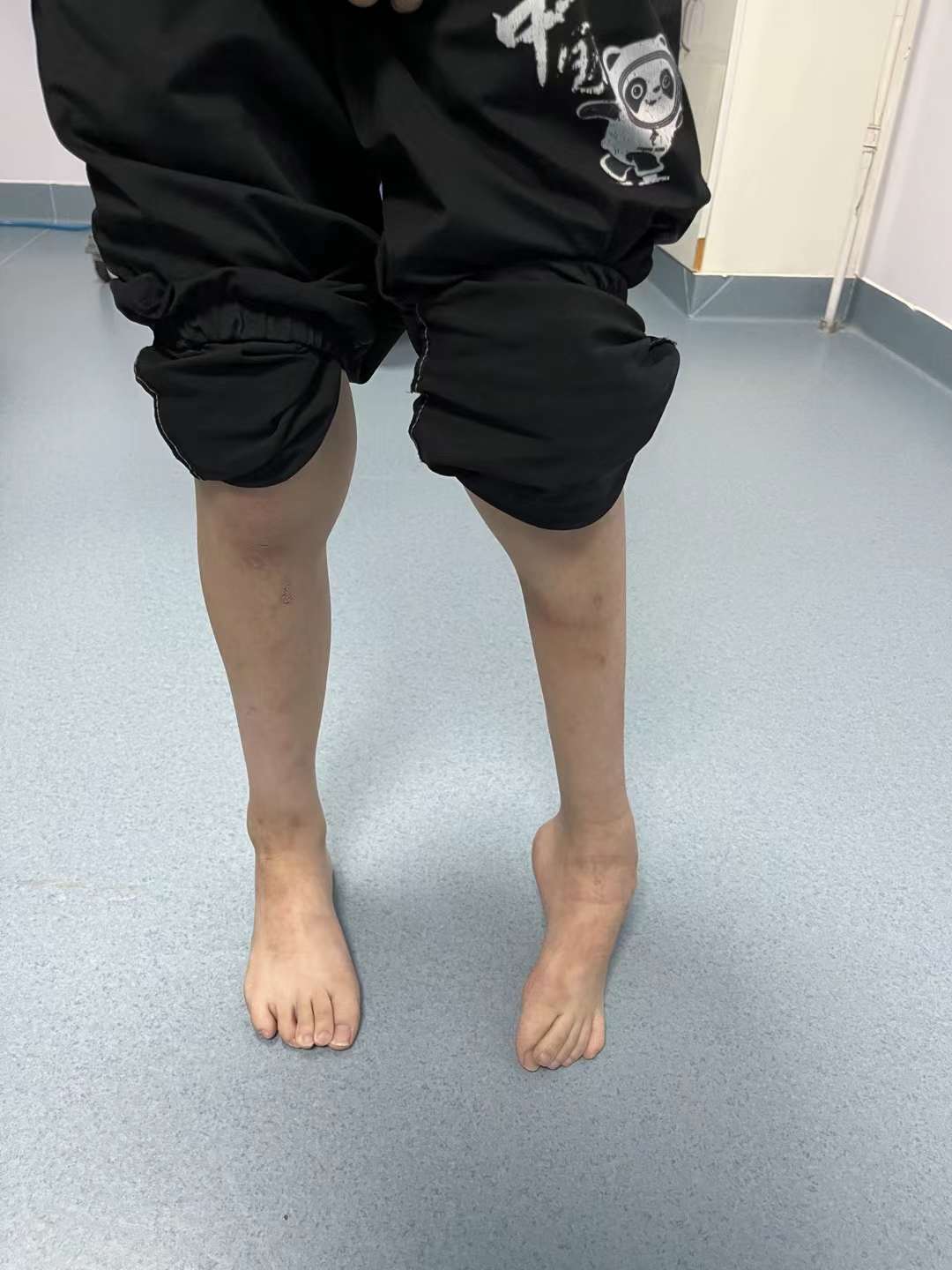 马蹄内翻足男孩的"奔跑梦":胡霞中医无创非手术技术改写畸形命运