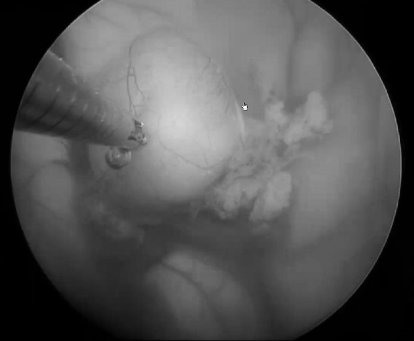 第三脑室胶样囊肿的神经内镜微创治疗