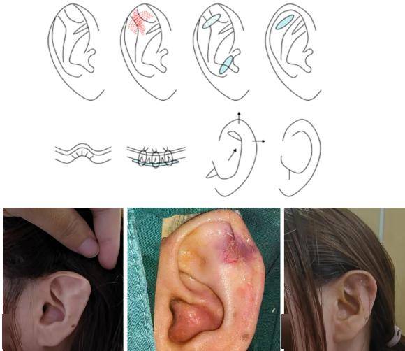 【科普】精灵耳(stahls ear)耳廓矫形术_解剖_畸形_耳科学