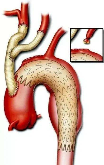 天气冷,注意身体里的这颗不定时炸弹:主动脉夹层_血管_症状_控制