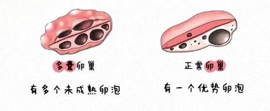 多囊卵巢b超图图片