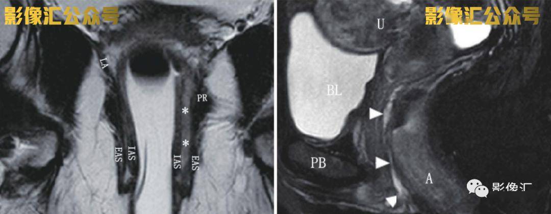 67肛瘻mri一看就頭疼?看看這個診斷要點!_括約肌_直腸_信號