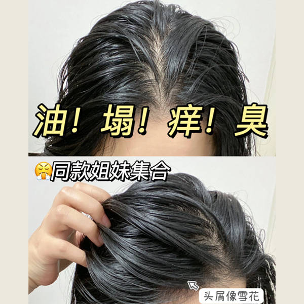 男士头发去屑用什么洗发水?