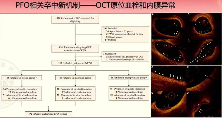 研究發現,卒中/tia組(n=43),偏頭痛組(n=49)和無症狀組