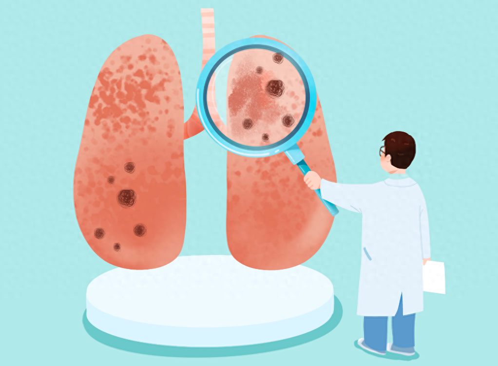 关于肺结节,这两个误区必须厘清——_患者_玻璃_肺部
