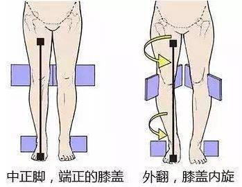 進而影響女生走路的姿勢,習慣性的用髖內收內旋位走路,頂胯擺髖,時間