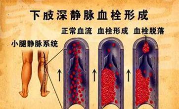 【健康科普】腿胖也是病,胖起來真要命_下肢_血栓_靜脈