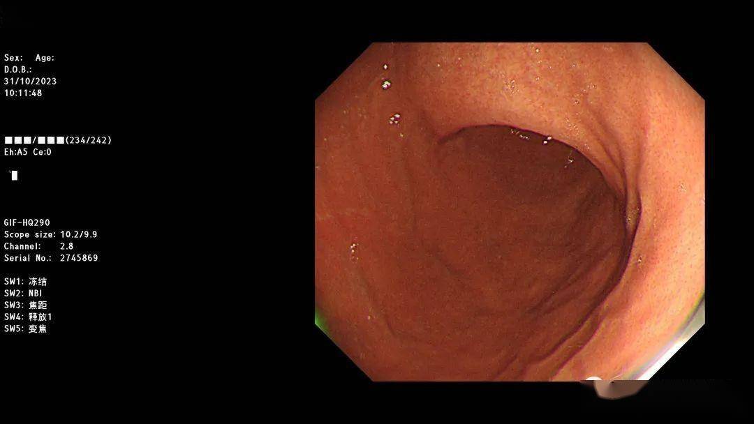 胃鏡的旋轉及攝圖_位置_部位_方向