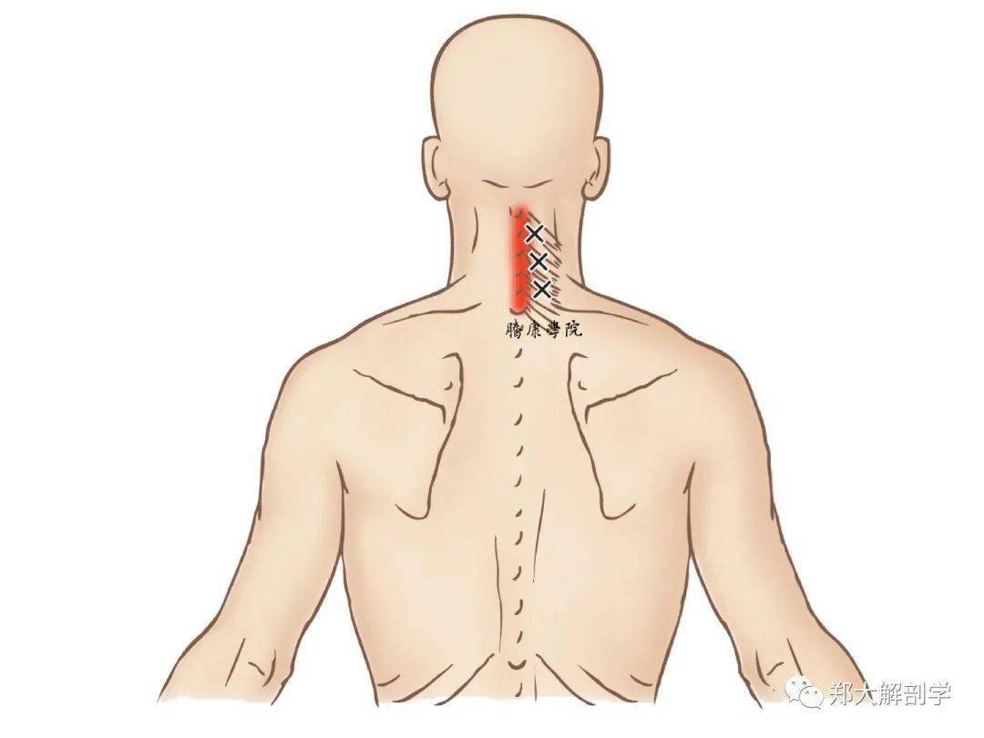 扳機點|頸迴旋肌_肌肉_症狀_影響