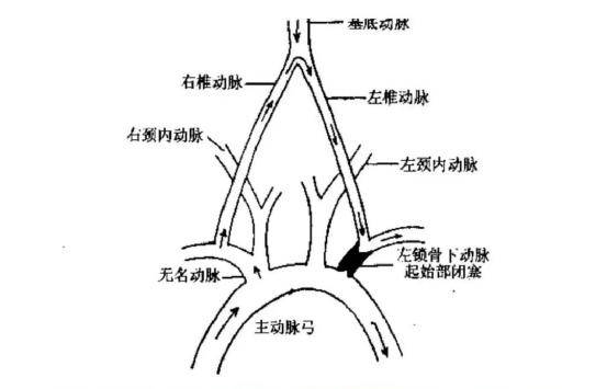 所以我们人体对大脑的供血是有备份系统的