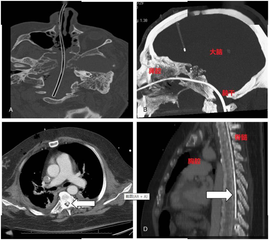 看看这个病例报道的ct:鼻胃管从鼻腔进入,穿破了颅底骨质(病人也是