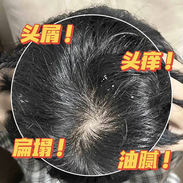 止痒去屑去油洗发水推荐_头皮_问题_头发