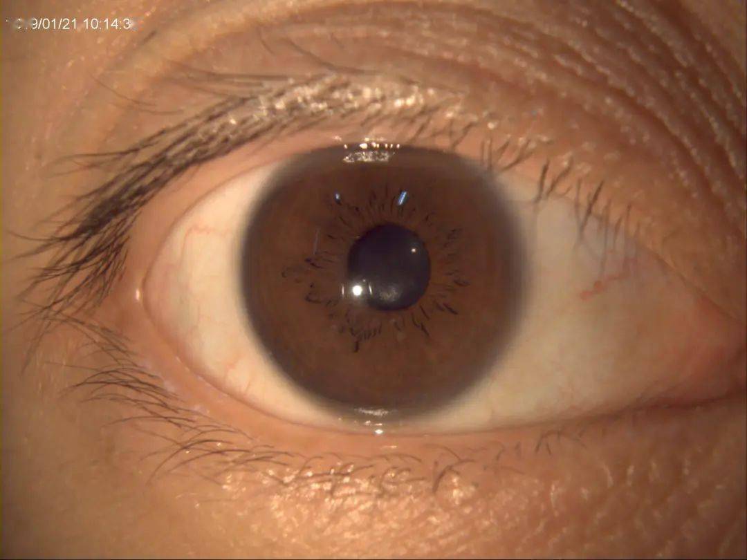 裂隙灯显微镜 | 常用检查方法图文高清对照版_角膜_照明_组织