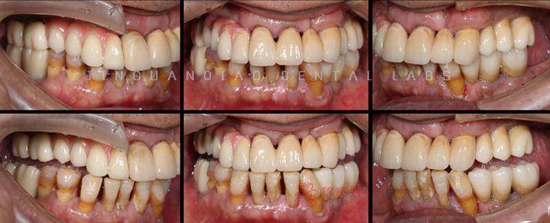 牙尖交错位蓝色:功能运动治疗前后对比术后总结1