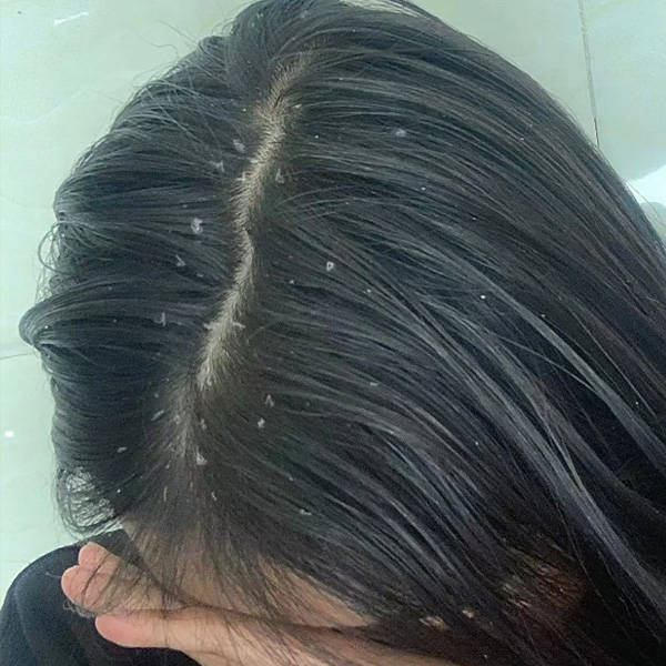 头皮问题产生的原因:头屑和头皮红疹产生的原因多种多样:②,蜂花去屑