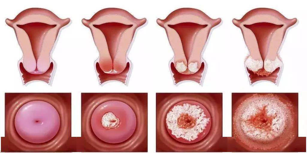 宫颈癌分泌物流血图片
