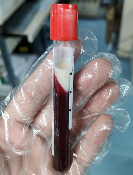 男子体内抽出"奶茶血",这几个习惯很多人都有_置换_血浆_患者