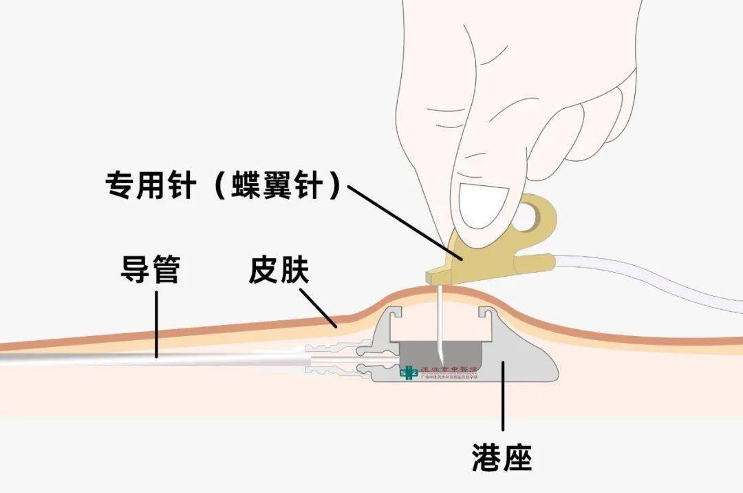 输液港组成图片