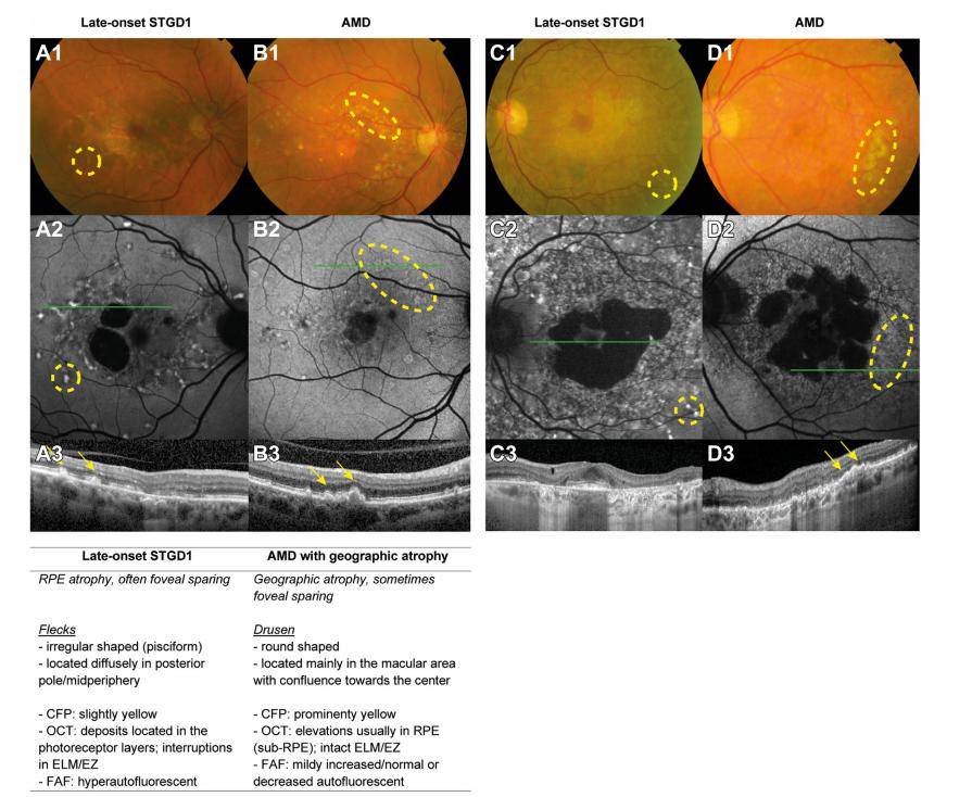 警惕!勿将晚发型1型stargardt病误诊为amd