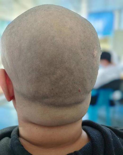 脑部横纹危害大,我们怎么预防它