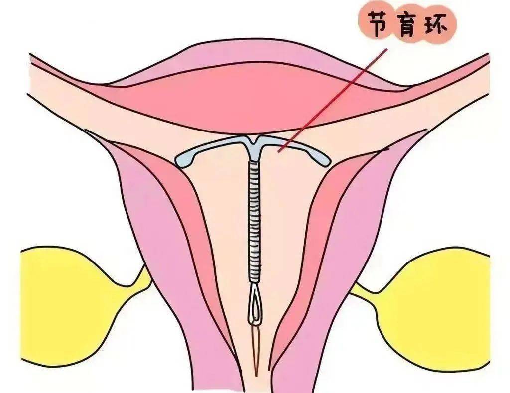 宫内环图片