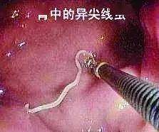 近日,福建宁德的赵女士(化名)出现肚子不适症状,过了几天又出现肛门